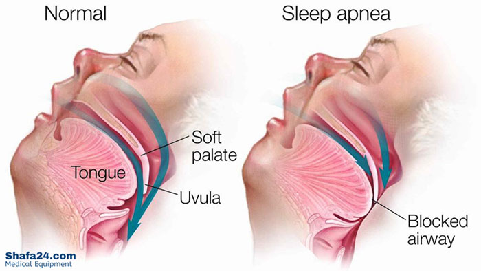 آپنه خواب - شفا24