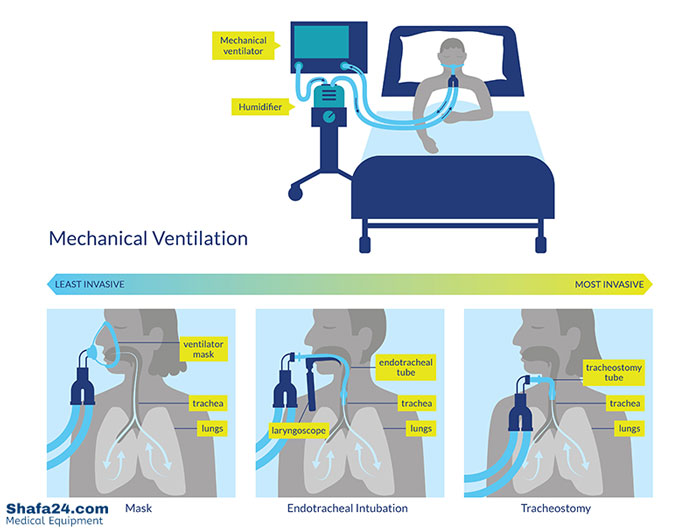 ونتیلاتور یا دستگاه تنفس مصنوعی - شفا24