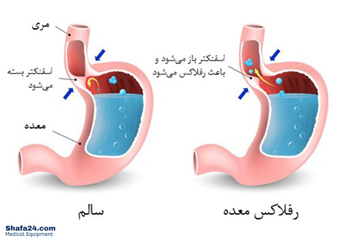 رفلاکس معده - شفا24