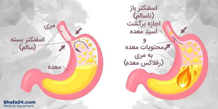 رفلاکس معده - شفا24